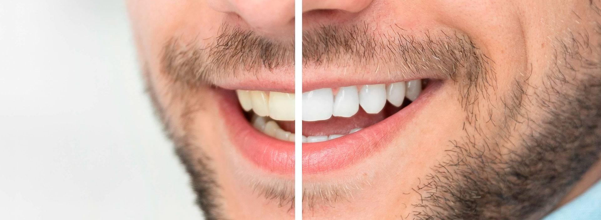 Blanqueamiento dental en Elda y Petrer, Clínica dental Comisura